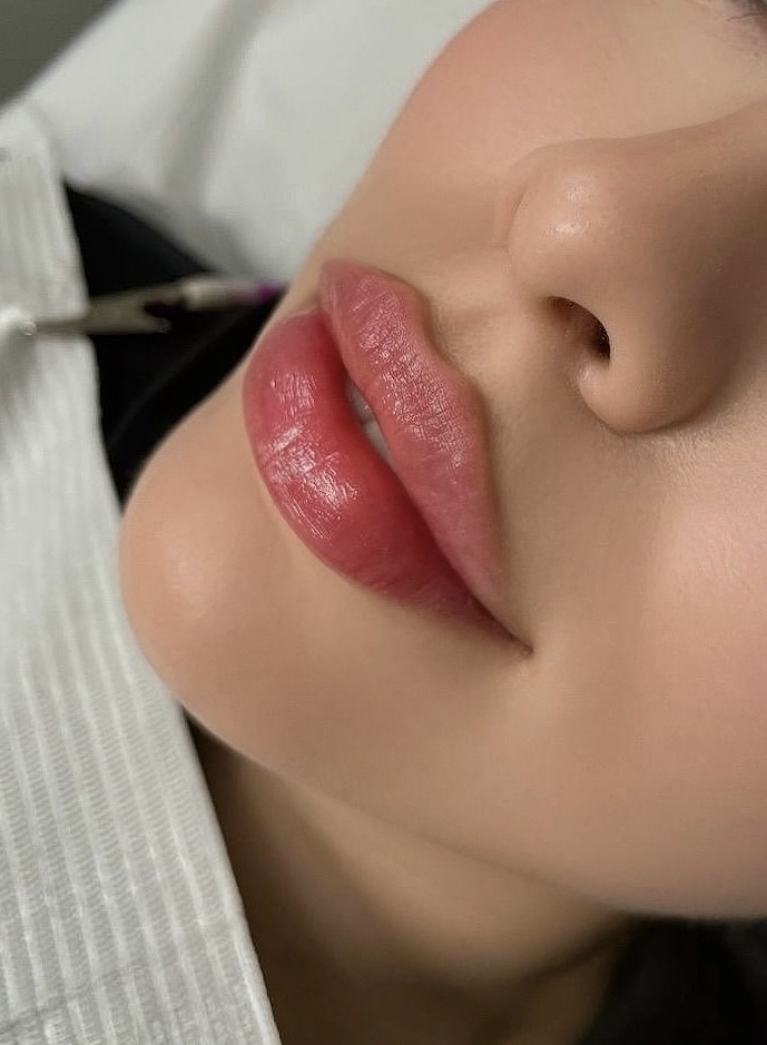 💉 Контурна пластика обличчя — 1