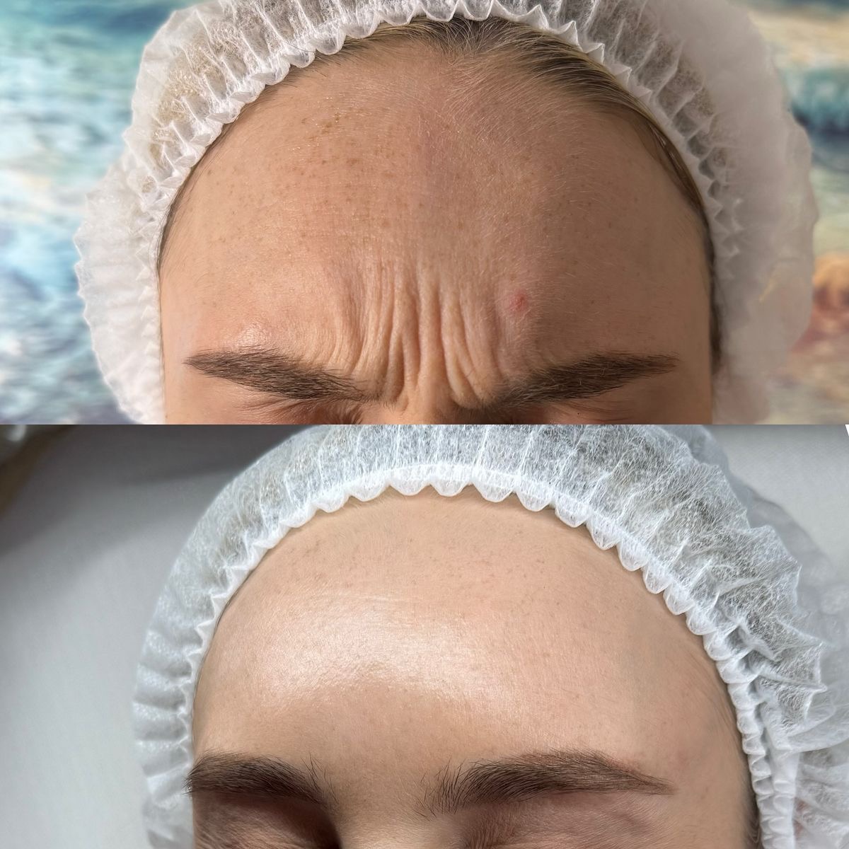 💉 Ботулінотерапія — 2